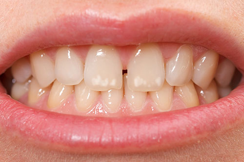 歯にできたホワイトスポット
