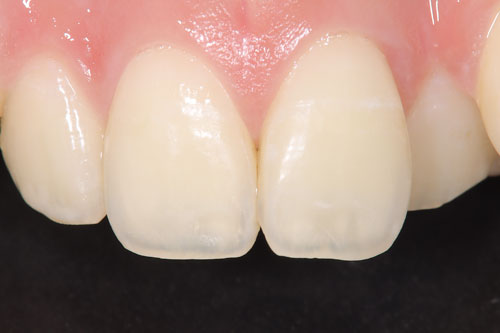 アイコン治療後の歯