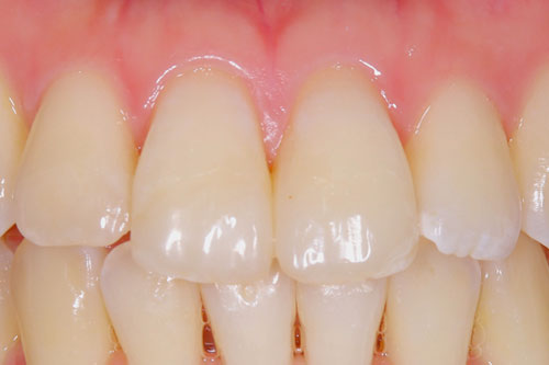 ダイレクトボンディング治療後の歯