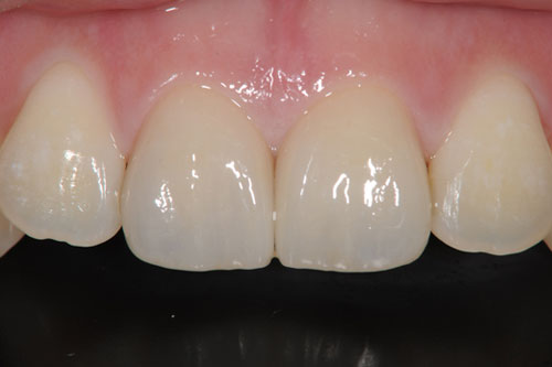 ラミネートベニア治療後の歯