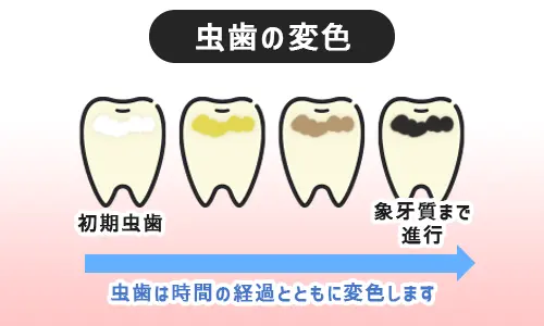 虫歯の変色の流れ