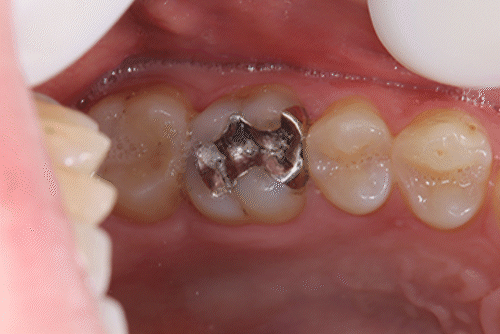 銀歯のやりかえの症例
