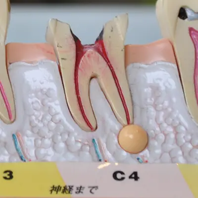 根尖性歯周炎の模型